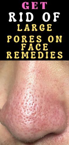 How To Get Rid Of Large OPEN PORES, DEEP ACNE SCARS & DARK SPOTS In Just 7 Days by FR Kitchen - Remove Pores On Face, Large Pores On Face, Large Pores On Nose, Pores On Nose, How To Remove Pores, Open Pores On Face, Pores On Face, Face Remedies, Get Rid Of Pores