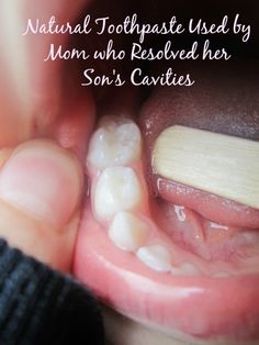 Healing Cavities, Heal Cavities, Natural Toothpaste, Natural Healing Remedies, Oil Pulling, Diy Remedies, Natural Therapy, Homemade Remedies, Diy Health