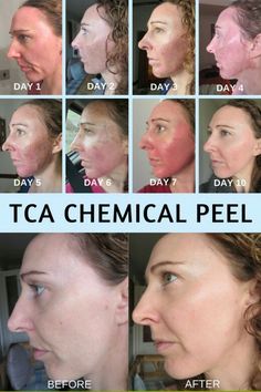 My experience under going a TCA chemical facial peel. Before and after chemical peel. Natural Aging Skin Care, Skin Peeling On Face, Chemical Peel At Home, Face Peel, Peeling Skin, Chemical Peel, Acne Skin, Anti Aging Skin Products