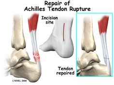 this is an image of the ankle and tendon repair