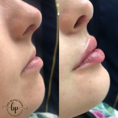 Small Lips With Filler, Lip Filler Examples, Flat Lips Filler, Lip Filler Inspo 0.5ml, First Time Lip Fillers, Lip Filler Pouty Lips, Lip Filler Half Syringe, Natural Lip Filler Inspiration