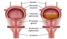 Bowel and Bladder Dysfunction Conditions Cause Incontinence Muscles, Conditioner