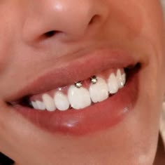 a close up of a person with braces on their teeth