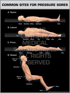 Common Sites For Pressure Sores Geriatrics Nursing, Ltc Nursing, Geriatric Nursing, Rehab Nursing, Med Surg Nursing, Bed Sores, Medical Surgical Nursing, Cardiac Nursing