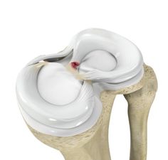 Meniscal root tears are devastating tears of the meniscal cartilage in the knee at the point where it connects to bone. In essence, the root is the anchor point of the meniscus. Such tears can lead to significant knee pain, dysfunction, instability and rapid development of osteoarthritis. Dupuytren's Contracture, Knee Strength, Knee Replacement, The Anchor, Knee Pain, The Knee, Essence