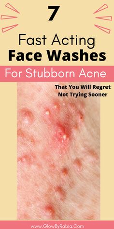 Looking for an acne face wash that actually works? Check this pharmacist Guide on the best acne face wash acne face wash, acne face wash best, acne face wash for sensitive skin, face wash for acne prone skin, face wash for acne, face wash for acne and oily skin, cleanser for acne, acne skincare routine, how to treat acne at home, salicylic acid cleanser, face wash for cystic acne, Best Face Wash For Acne Prone Skin, Best Face Wash For Acne, Best Natural Face Wash