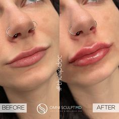 Lip Injection Before & After Gallery | OMNI SCULPT MD