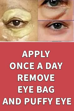 Eye Bag Remedies, Puffy Eyes Remedy, Puffy Eye, Wrinkles Remedies Face, Remove Eye Bags, Eye Skin Care, Natural Face Skin Care, Skin Care Wrinkles, Eye Wrinkle