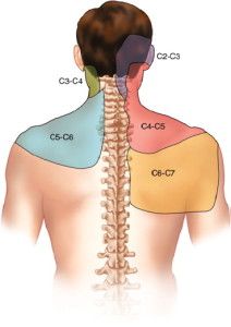 Pain patterns from damage to the facet joints of the cervical spine. This is the most common source of chronic neck pain from whiplash. Chronic Back Pain, Cervical Spine, Neck And Back Pain, Joints Pain Relief, Body Pain