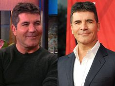 Simon Cowell Before And After Plastic Surgery Facelift, Botox Plastic Surgery Quotes, Plastic Surgery Procedures, Nose Surgery, Botox Injections