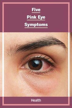 Learn about pink eye (conjunctivitis) symptoms, as well as some of the most common causes, treatments, and when to see a healthcare provider. Pink Eye Infection, Pink Eye Symptoms Signs, Pink Eye Remedy How To Get Rid Of, How To Get Rid Of Pink Eye Fast, Pink Eye Remedy, Pinkeye Remedies, Natural Remedies For Migraines, Eye Problems, Eye Infections