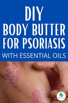 DIY body butter for psoriasis using essential oils Make Body Butter, Essential Oil Spray Recipes, Natural Oils For Skin, Diy Body Butter, Skin Remedies, Diy Body