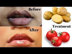 Upper Lip Pigmentation Remedy, Lips Darkness Remove, How To Remove Dark Lips, How To Remove Pigmentation Around Mouth, Upper Lip Darkness How To Remove, Black Lips Remedy, Dark Skin Around Mouth, Darkness Around Mouth, Remedies For Dark Lips