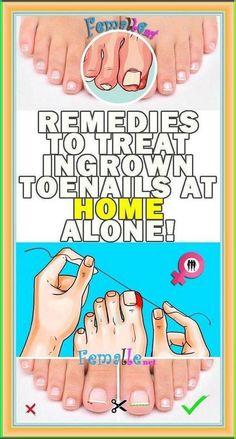 10 REMEDIES FOR INGROWN TOENAILS Ingrown Toenail, Ingrown Nail, Health Signs, Tongue Health, Ingrown Toe Nail, Toenail Fungus, Health Guide, Nail Fungus, Homemade Remedies