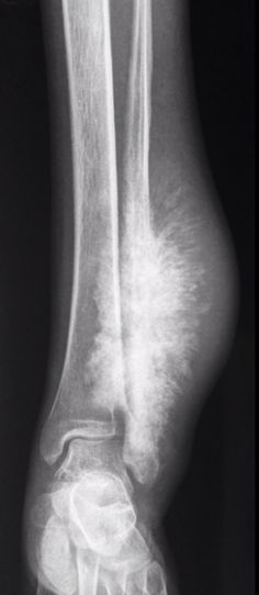 an x - ray image of the foot and ankle with no shoes or pads on