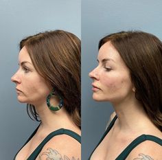 Cheek Augmentation Before After, Chin Enhancement Before After, Jawline Surgery Before After, Jawline Before And After, Cheek Filler Before And After, Facial Fillers Before And After, Jaw Surgery Before And After, Jaw Filler Before And After, Jaw Botox Before After