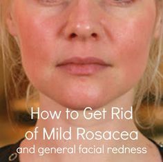 Roscea Help, Red Face Remedies, Redness Remedy, Reduce Face Redness, Redness On Face, Skin Therapist, Dry Skin On Face, Anti Redness, Acne Skincare