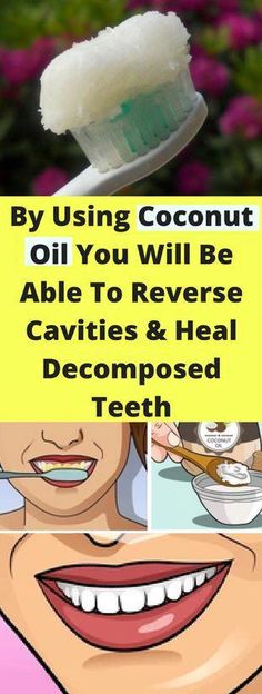 By Using Coconut Oil You Will Be Able To Reverse Cavities And Heal Decomposed Teeth - seeking habit #WhatIsOralCare Teeth Decay, Health Coconut Oil, Heal Cavities, Dental Health Care, Coconut Oil Uses, Benefits Of Coconut Oil, Coconut Oil For Skin