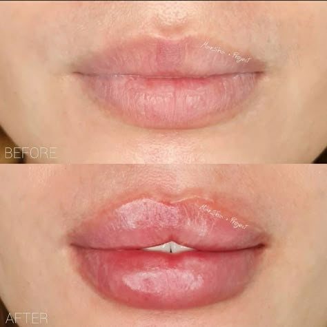 Key Hole Lips Injections, Pillow Lips Injections, Keyhole Lip Injections, Russian Keyhole Lips, Lip Filler Shape Ideas Pouty, Lip Gel Injection, Keyhole Pout Lips, Bratz Doll Lip Filler, Change Lip Shape