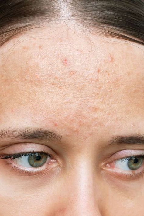 Types Of Acne On Face, How To Get Rid Of Closed Comedones, Closed Comedones, Natural Remedies For Acne, Comedonal Acne, Cystic Acne Remedies, Remedies For Acne, Forehead Acne, Acne Overnight