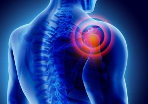 Homeopathy for Frozen Shoulder - Homeopathy Plus What Is Frozen Shoulder, Shoulder Pain Remedies, Rotator Cuff Injury, Shoulder Brace, Frozen Shoulder, Rotator Cuff, Shoulder Pain, Muscle Pain, Homeopathy