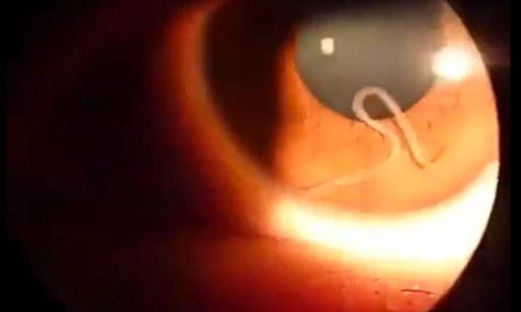 Horrific video shows a live worm wriggling inside a woman's EYE White Worms, Parasitic Worms, Enough Is Enough, Daily Mail, In This Moment