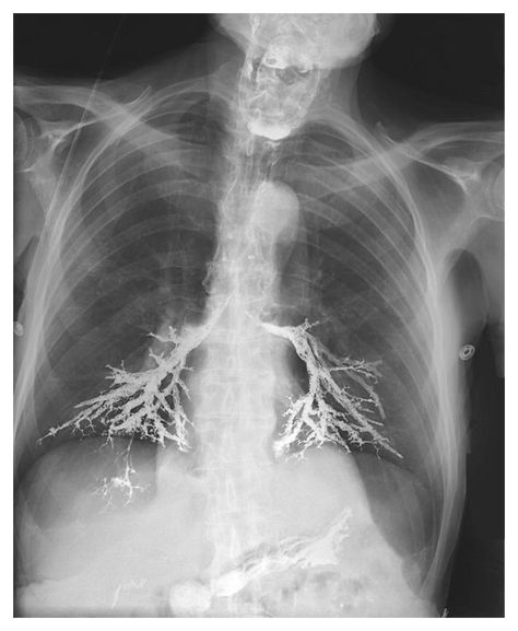 Cool looking bronchogram Disease Aesthetic, Aspiration Pneumonia, Xray Art, Respiratory Care, Acute Care, Garden On A Hill, Center Of Excellence, Medical Education, Radiology