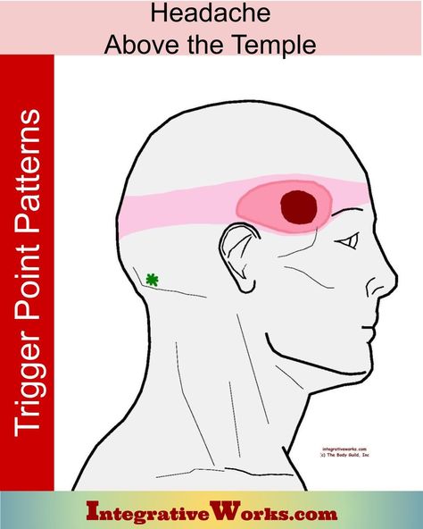 How people describe this pain, what causes or intensifies the pain, links to anatomy, self-care, and therapist notes. Temple Headache, Forward Head Posture Exercises, Anatomy Medical, Forward Head Posture, Headache Types, Tension Headache, Self Massage, Headache Relief, Acupressure Points