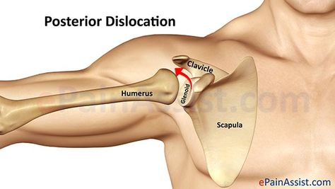 Shoulder Dislocation, Sports Injury, Fitness Instructor, Shoulder Pain, Action Poses, Going To Work, In Dubai, Skiing, Dubai