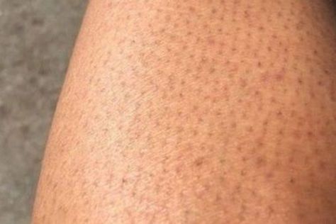 Strawberry Legs Aesthetic, Leg Scars, Strawberry Skin, Glove Design, Thick Hair Growth, Strawberry Legs, Chemical Exfoliation, Dry Flaky Skin, Exfoliating Gloves