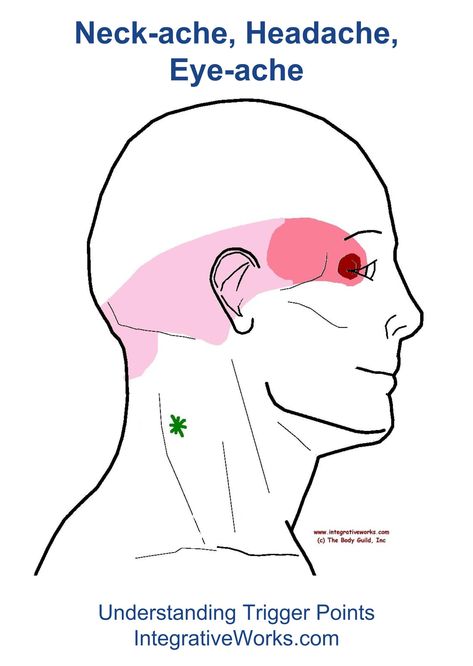 Headache Behind Eyes, Trigger Points Neck, Acupressure Headache, Punkty Spustowe, Forward Head Posture Exercises, Sinus Congestion Relief, Neck Ache, Natural Headache, Constant Headaches