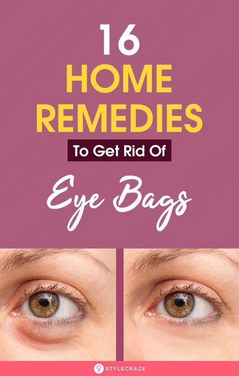 Get Rid Of Eye Bags, Rid Of Eye Bags, Eye Bag Remedies, Puffy Eyes Remedy, Baggy Eyes, Cucumber Slices, Under Eye Puffiness, Under Eyes, Eye Wrinkle