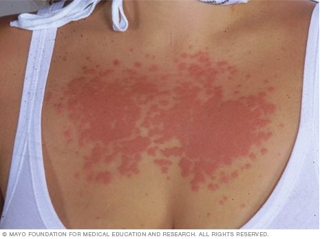 Sun allergy - Symptoms and causes Polymorphic Light Eruption, Immune System Activities, Facial Warts, Sun Allergy, Itchy Rash, Invisible Disease, Tanning Bed, Allergy Symptoms, Mayo Clinic