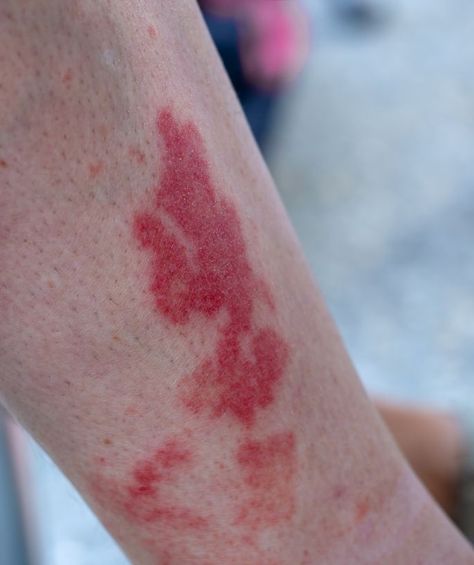 Learn what causes the Disney Rash, as well as a nurse's tips for preventing and treating this rash that often plagues Disney World guests! Disney World Height Requirements, Disney Rash, Types Of Rashes, Red Moles, Prickly Heat, Moisture Wicking Socks, Disney Countdown, Heat Rash, Sweat Gland