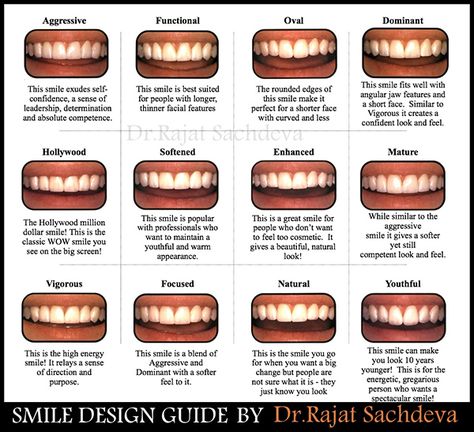 Smile Design Dental Teeth, Different Types Of Smiles, Smile Design Dental, Free Dental Implants, Dental Smile, Design Analysis, Cosmetic Dentistry Procedures, Dental Aesthetics, Veneers Teeth