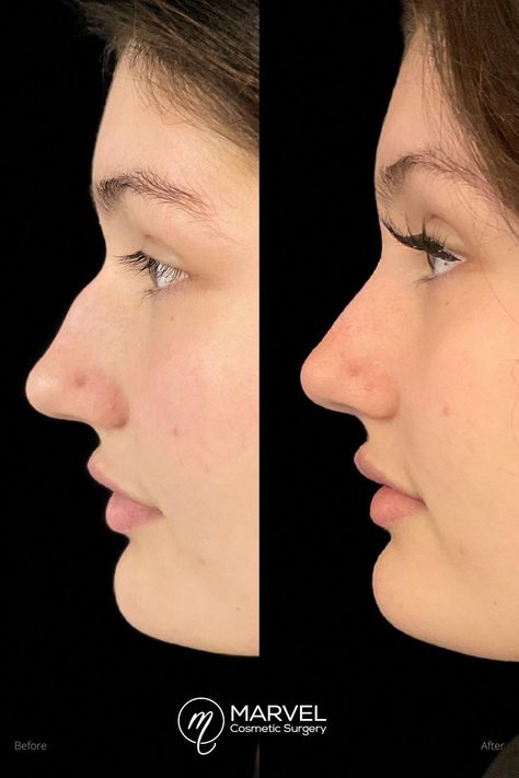 Bump Nose Bridge, Nose Hump Aesthetic, Straight Nose With Bump, Dorsal Hump Rhinoplasty, Nose With A Bump, Dorsal Hump Nose, Straight Nose Bridge, Nose Bump, Rhinoplasty Before And After