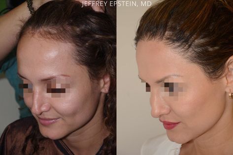 Patient 54085, Hair Transplants for Women before and after photos Losing Hair Women, Hair Transplant Women, Eyebrow Transplant, Before And After Hair, Hair Transplant Results, Female Pattern Baldness, Miami Photos, Hair System, Lost Hair