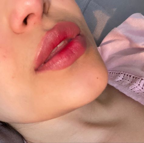 Lip Filler Reference Photos, Downturned Lips Aesthetic, Lip Filler Natural, Korean Lip Filler, Plump Lips Aesthetic, Plump Lips Naturally Aesthetic, Lip Filler Inspo 1 Ml, Lip Filler No Cupids Bow, Desired Lips