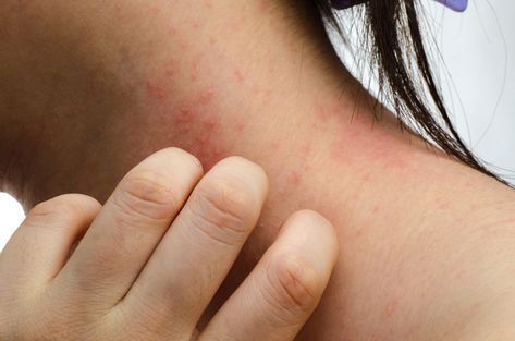 Allergic Contact Dermatitis: Itchy Redness - most common causes of allergic contact dermatitis (ACD), with the chemicals/fragrances included in shampoos and conditioners Hair Dye Allergy, Orange Power, Itchy Rash, Heat Rash, Best Lotion, Scaly Skin, Skin Disorders, Itchy Skin, Skin Conditions