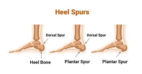 calcaneal spur Calcaneal Spur, Heel Spur, Calcium Deposits, Ligaments And Tendons, Physical Activity, Physical Therapy, Physical Activities, Physics, Heels