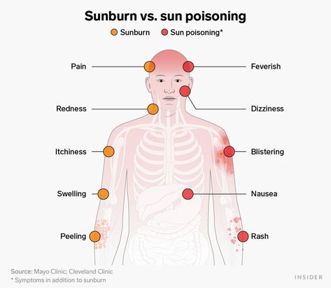 How to treat sunburn with aloe vera, cool water, moisturizer, and more - Insider Really Bad Sunburn, Sunburn Blisters, How To Treat Sunburn, Aloe Vera For Sunburn, Natural Remedies For Sunburn, Water Moisturizer, Bad Sunburn, Warts Remedy, Sunburn Remedies