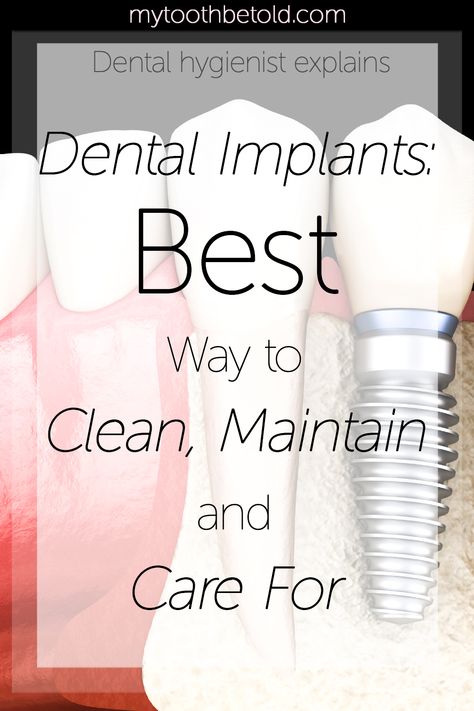 Dental Implants Before And After, All On 4 Dental Implants, Dental Hacks, Implants Dental, Dental Quotes, Denture Implants, Best Dental Implants, Dental Implant Surgery, Dental Implants Cost