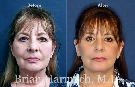 Deep Plane Facelift, Dermal Fillers Lips, Facelift Before And After, Facelift Procedure, Forehead Lift, Facial Aging, Medical Aesthetician, Laser Skin Resurfacing, Face Lift Surgery