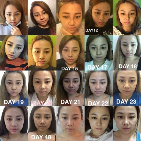 MY RHINOPLASTY PLASTIC SURGERY JOURNEY | PART 2 (END) Rhinoplasty Swelling Progression, Rhinoplasty Recovery Timeline, Nose Job Recovery, Rhinoplasty Recovery, Upturned Nose, Hospital Nurse, Communication Problems, Medical Tourism, Nose Job