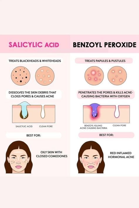 If you have any of this acne in my page i have the right product you need to fight this acne. Skin Facts, Skin Advice, Skin Care Routine Order, Clear Healthy Skin, Natural Acne Remedies, Basic Skin Care Routine, Benzoyl Peroxide, Healthy Skin Tips, Facial Skin Care Routine