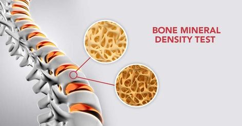 A bone density scan, also called a DEXA scan, is a type of low-dose x-ray test that measures calcium and other minerals in your bones. The measurement helps show your bones' strength and thickness.You might also be at risk for low bone density if you: 1.Have a very low body weight 2.Have suffered one or more fractures after the age of 50 3.Have lost a half inch or more in height within 1 year 4.Are a male over 70 years of age 5.Have a family history of osteoporosis Low Bone Density, Bone Density, X Ray, Family History, Body Weight, Density, Bones, Lost, Regional