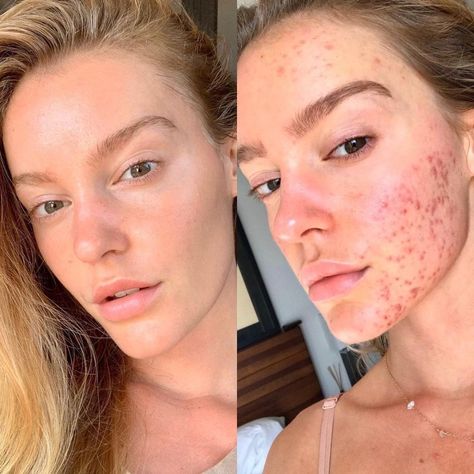 A MODEL who battled chronic acne for two years has revealed her  incredible skin transformation after changing her  diet. Georgia Gibbs, who comes from Perth in Western Australia, suffered from outbreaks of spots on her forehead, cheeks and chin. The Sports Illustrated model shared shocking before and after photos of how her skin has changed […] Before And After Acne, Skin Transformation, Yoga Facial, How To Get Rid Of Acne, Skin Care Solutions, Acne Skin, Perfect Skin, Dull Skin, Skin Rejuvenation