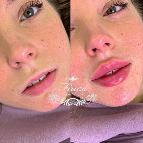 Lip Fillers On Small Lips, Nose Job And Lip Fillers, 1ml Of Lip Filler, Lip Flip Aesthetic, Lip Injections Natural, Lip Fillers 2ml, Lip Implants Before And After, Russian Style Lip Fillers, Lip Injection Inspiration