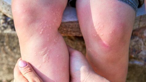 Gluten Allergy Rash, Hives Relief, Hives Causes, Allergy Hives, Hives Remedies, Allergy Rash, Chronic Hives, C Reactive Protein, Viral Infection