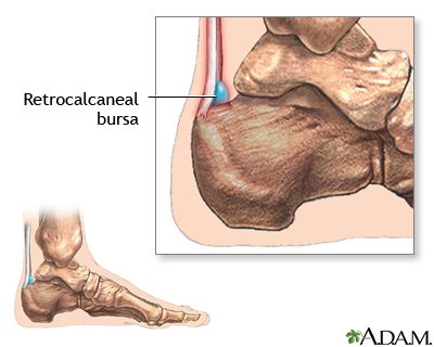 Heel pain Retrocalcaneal bursitis Retrocalcaneal Bursitis, Custom Heels, Body Joints, Orthopedic Surgery, Strong Muscles, Calf Muscles, Improve Flexibility, Heel Pain, Workout Schedule